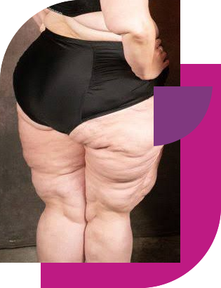 Otimizando o tratamento do Lipedema
